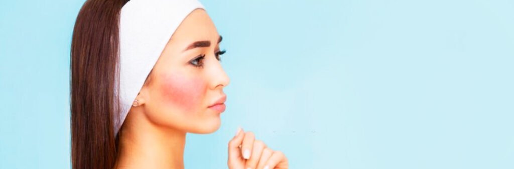 Memicu Rosacea